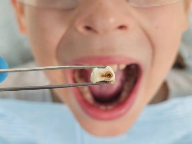 Best Emergency Root Canal Treatment in Pymatuning Central, PA
